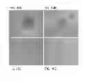 Fig. 14 - Reverse thermal gels and their use in cell therapy