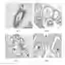 Fig. 02 - Methods for treating benign prostatic hypertrophy (BPH)