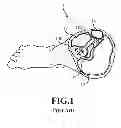 Fig. 02 - PRESSURE MEASURING DEVICE AND FIXING DEVICE WITH PRESSURE MEASURING FUNCTION FOR AFFECTED PART