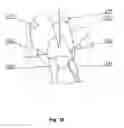 Fig. 06 - Device for correcting ingrowing foot nails and a method for cosmetic correction of ingrowing foot nails