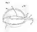 Fig. 02 - Capsulotomy device