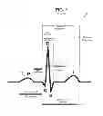 Fig. 02 - System and method for triggering conditioning of the heart using the intrinsic heartbeat