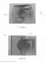 Fig. 12 - Adjustable and biased-open unidirectional speaking valve
