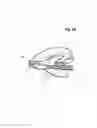 Fig. 40 - Incremental and/or successive adjustable mandibular advancement device for preventing and treatment of snoring and obstructive sleep apnea