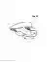 Fig. 45 - Incremental and/or successive adjustable mandibular advancement device for preventing and treatment of snoring and obstructive sleep apnea