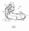 Fig. 02 - ORAL APPLIANCE FOR PROTECTING THE TEETH OF A USER