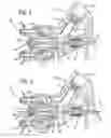 Fig. 04 - Fluid through needle for applying multiple component material