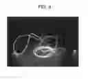 Fig. 07 - Uniform illumination light diffusing fiber device