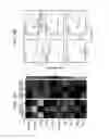 Fig. 04 - Combination therapy to prevent DCIS formation and progression to breast cancer