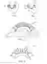 Fig. 03 - Lingual orthodontic appliance with removable section