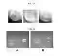 Fig. 11 - Interpenetrating Polymer Network Hydrogel