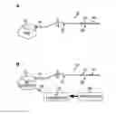 Fig. 01 - Deep brain stimulation of the subcallosal cingulate area for treatment of refractory anorexia nervosa
