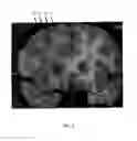 Fig. 04 - Deep brain stimulation of the subcallosal cingulate area for treatment of refractory anorexia nervosa