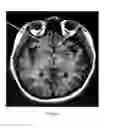 Fig. 06 - Deep brain stimulation of the subcallosal cingulate area for treatment of refractory anorexia nervosa