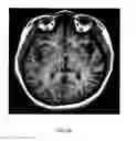 Fig. 07 - Deep brain stimulation of the subcallosal cingulate area for treatment of refractory anorexia nervosa
