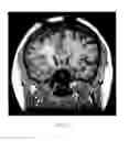 Fig. 08 - Deep brain stimulation of the subcallosal cingulate area for treatment of refractory anorexia nervosa