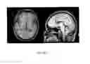 Fig. 09 - Deep brain stimulation of the subcallosal cingulate area for treatment of refractory anorexia nervosa