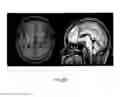 Fig. 10 - Deep brain stimulation of the subcallosal cingulate area for treatment of refractory anorexia nervosa