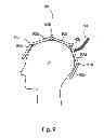 Fig. 08 - mTMS coil device with overlapping coil windings