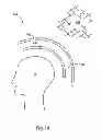 Fig. 14 - mTMS coil device with overlapping coil windings