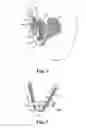 Fig. 03 - Implants, tools, and methods for treatment of pelvic conditions