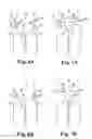 Fig. 05 - Implants, tools, and methods for treatment of pelvic conditions