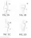 Fig. 04 - HIGH TORQUE PERSONAL MASSAGER