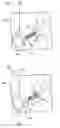 Fig. 01 - TISSUE SPREADER FOR ACCESSING PAPILLA, AND RELATED METHODS OF USE