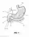 Fig. 02 - TISSUE SPREADER FOR ACCESSING PAPILLA, AND RELATED METHODS OF USE