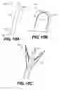 Fig. 11 - TISSUE SPREADER FOR ACCESSING PAPILLA, AND RELATED METHODS OF USE