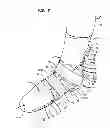 Fig. 03 - Toe Walker Orthosis
