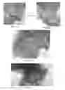 Fig. 06 - System and method for blood filtering and/or treatment