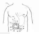 Fig. 01 - Intraluminal Sleeve with Stimulation Electrode