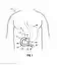 Fig. 02 - Intraluminal Sleeve with Stimulation Electrode