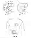 Fig. 08 - Intraluminal Sleeve with Stimulation Electrode