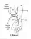 Fig. 01 - ARTERIOVENOUS FISTULA