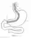 Fig. 07 - METHODS FOR TOPOSCOPIC SLEEVE DELIVERY