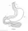 Fig. 09 - METHODS FOR TOPOSCOPIC SLEEVE DELIVERY