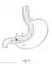 Fig. 16 - METHODS FOR TOPOSCOPIC SLEEVE DELIVERY