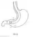 Fig. 17 - METHODS FOR TOPOSCOPIC SLEEVE DELIVERY
