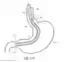 Fig. 19 - METHODS FOR TOPOSCOPIC SLEEVE DELIVERY