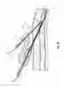 Fig. 09 - Devices for creation of multiple vascular access sites
