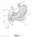 Fig. 02 - VACUUM-ASSISTED PANCREATICOBILIARY CANNULATION