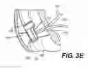 Fig. 06 - VACUUM-ASSISTED PANCREATICOBILIARY CANNULATION
