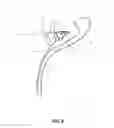 Fig. 03 - Method and apparatus for providing arthroscopic microfracture therapy