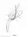 Fig. 04 - Method and apparatus for providing arthroscopic microfracture therapy