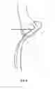 Fig. 09 - Method and apparatus for providing arthroscopic microfracture therapy