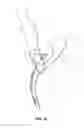 Fig. 17 - Method and apparatus for providing arthroscopic microfracture therapy