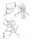 Fig. 22 - SURGICAL DISTRACTION DEVICE WITH EXTERNAL ACTIVATION