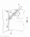 Fig. 14 - Method and apparatus for performing anterior hip surgery